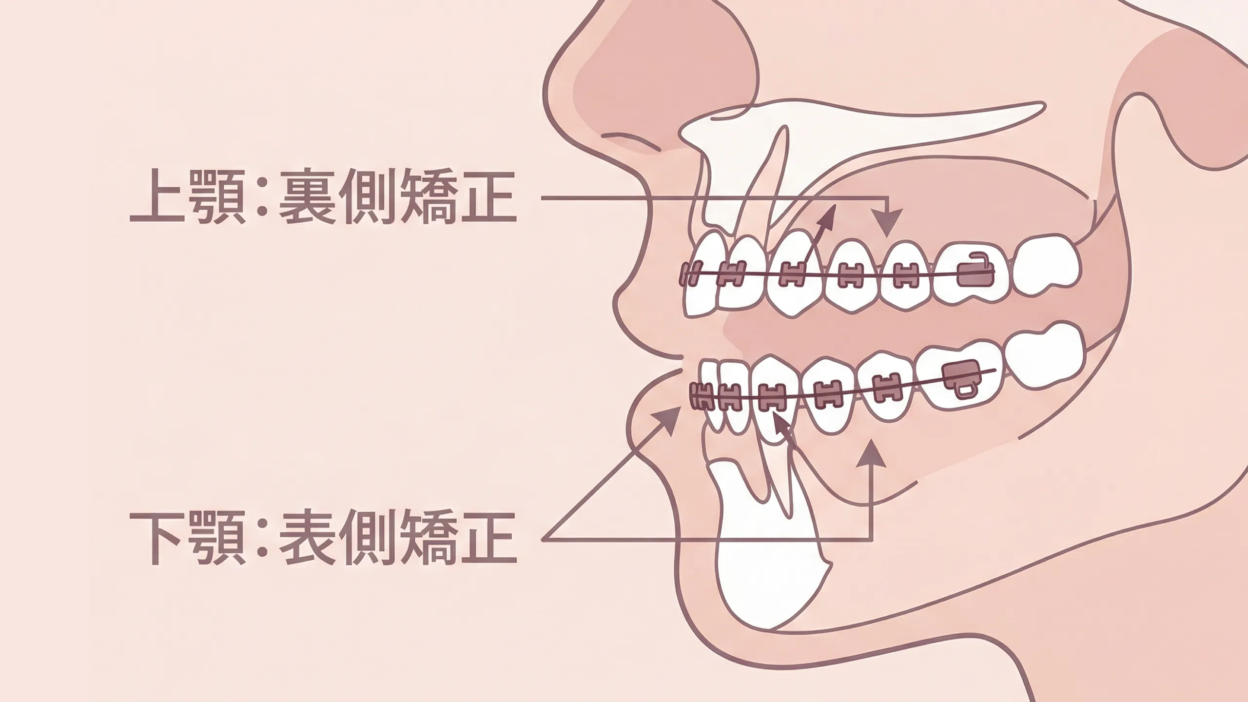 ハーフリンガル矯正画像