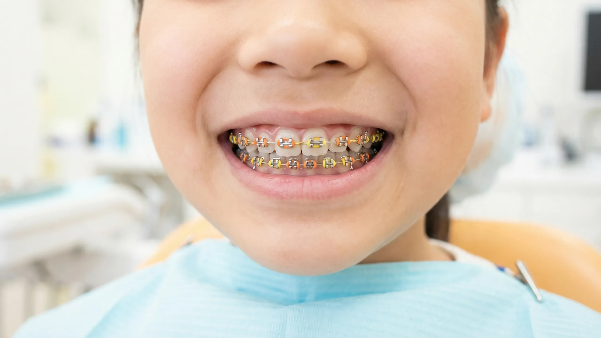 ワイヤー矯正装置画像