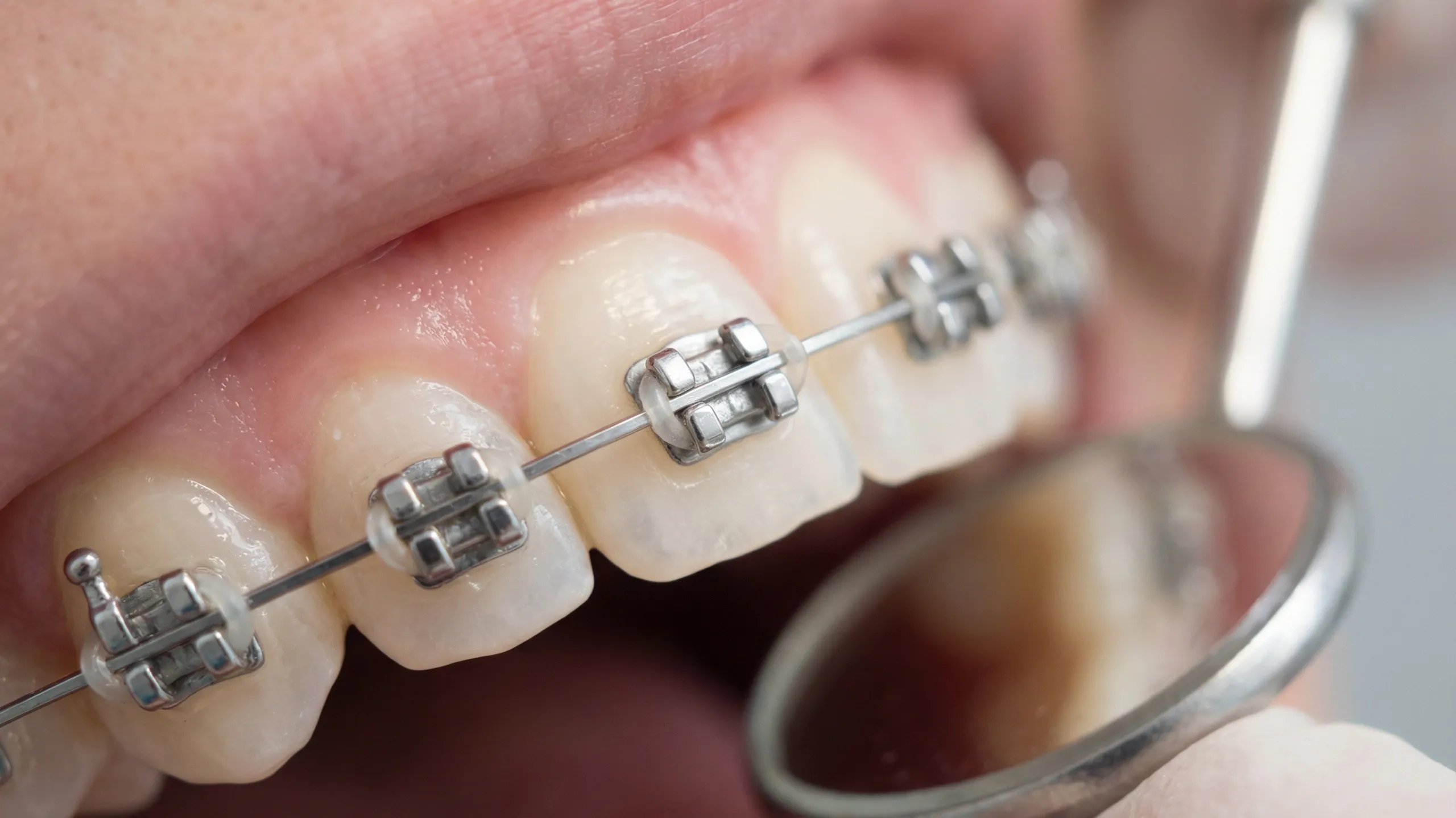 表側矯正（ラビアル矯正）画像