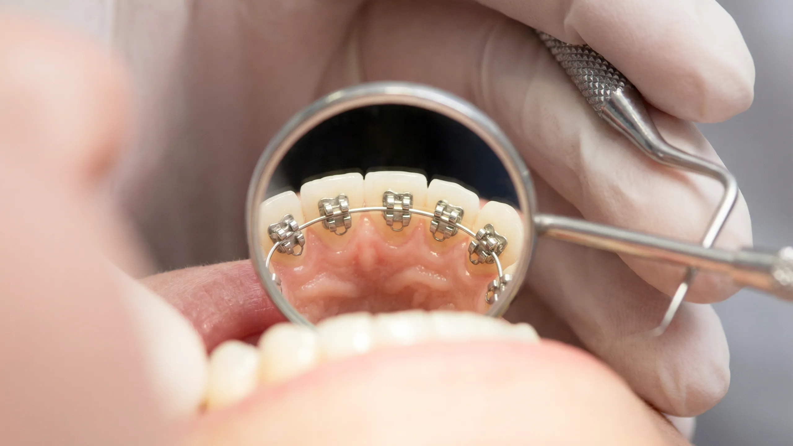 裏側矯正装置画像