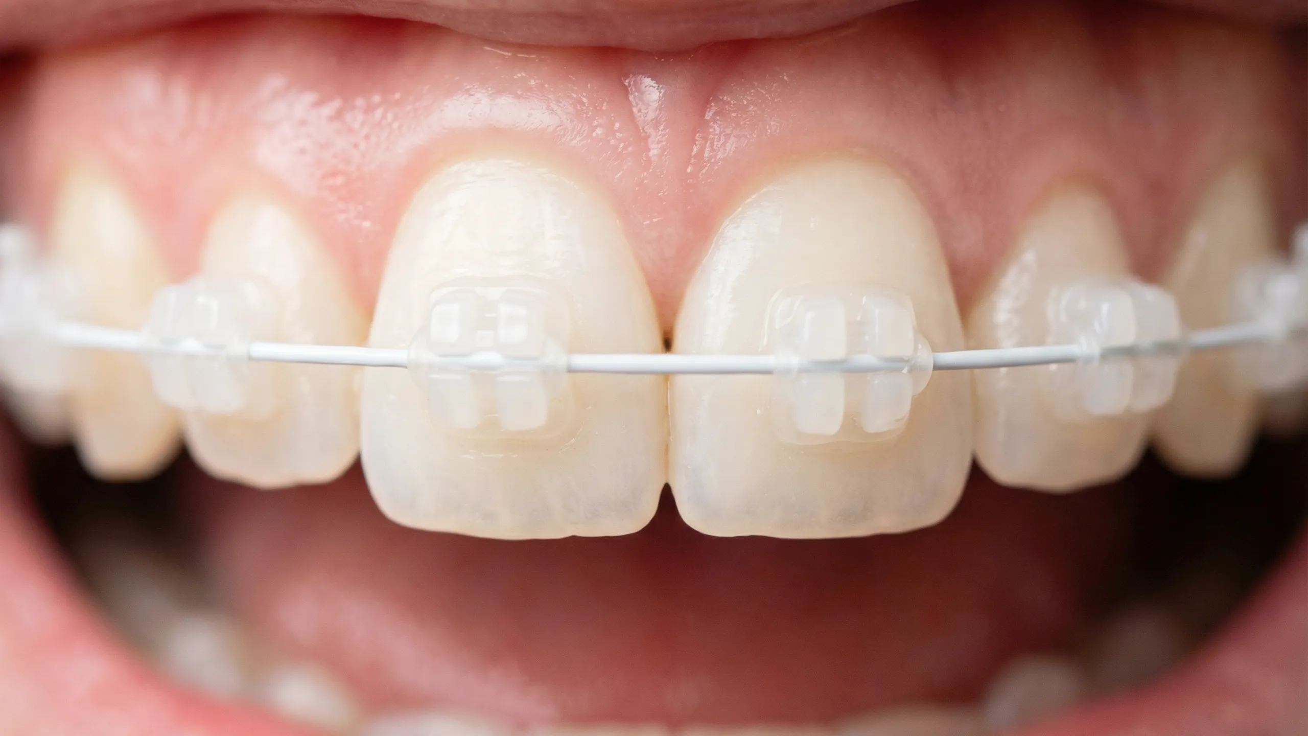 部分ワイヤー矯正（表側）画像