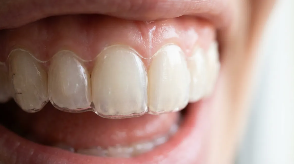 矯正装置が目立ちにくい